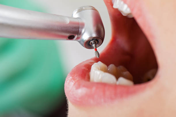 Best Emergency Tooth Extraction in Vienna, IL